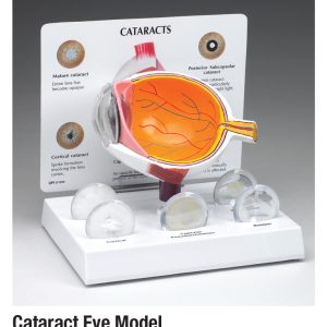 Cataract Eye Model