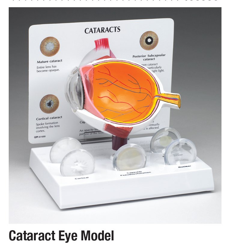 Cataract Eye Model